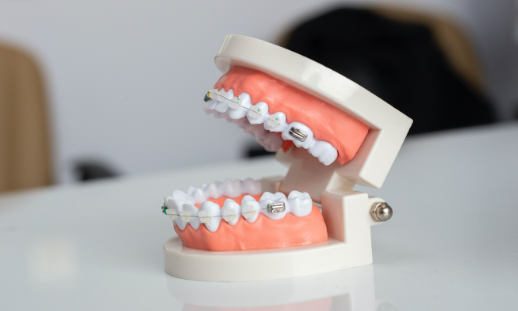 Clear Braces, Ceramic Braces Canberra