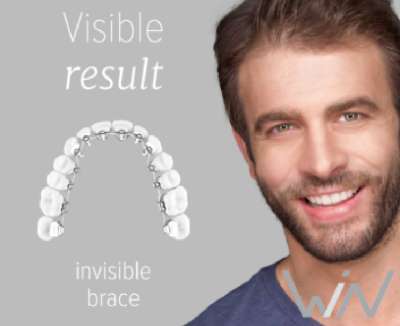 Orthodontist Specialist Clinic Canberra Capital Smiles - invisible brace
