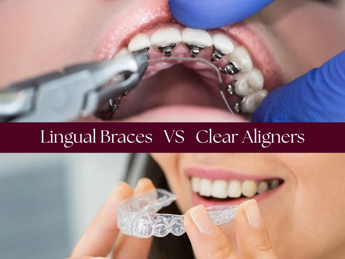 Lingual Braces vs Clear Aligners